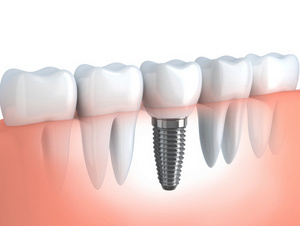 Image of a dental implant model at Shull Family Dentistry in Salem, Or.