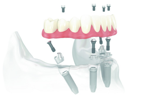 Photo of all on 4 implant from Shull Family Dentistry in Salem, Or