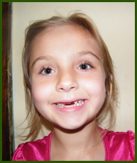 Girl with missing front tooth, at Shull Family Dentistry, in Salem, Or.